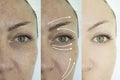 Woman face wrinkles before and after c regeneration orrection treatment Royalty Free Stock Photo