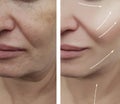 Woman face wrinkles before and after contrast patient rejuvenation therapy difference procedures, arrow Royalty Free Stock Photo