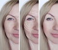 woman face wrinkles cosmetology treatment dermatology beautician removal before and after procedures, arrow Royalty Free Stock Photo