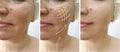 Woman face wrinkles correction arrow regeneration before and after correction procedures, collage Royalty Free Stock Photo