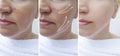 Woman face wrinkles correction arrow treatment regeneration before and after correction procedures, collage Royalty Free Stock Photo