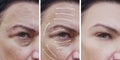 Woman face wrinkles correction regeneration contrast before and after procedures, arrow Royalty Free Stock Photo