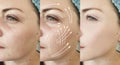Woman face wrinkles before after correction rejuvenation treatment, arrow Royalty Free Stock Photo