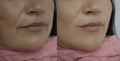 Woman face wrinkles before and after saggy patient double chin treatment