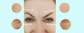 Woman face wrinkles face eye aging removal puffiness lifting before and after collage treatment Royalty Free Stock Photo