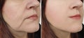 Woman face wrinkles face lifting before and after difference treatment