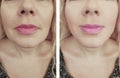 Woman face wrinkles before and after lifting biorevitalization regeneration antiaging cosmetology treatment