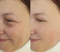 Woman face wrinkles before and after lifting correction treatment tension , collage revitalization correction problem plastic