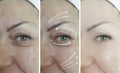 Woman face   wrinkles before and after  lifting  regeneration orrection treatment Royalty Free Stock Photo