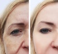 Woman face wrinkles pigmentation aging removal before and after procedures Royalty Free Stock Photo