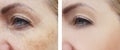 Woman face wrinkles pigmentation difference correction treatment health before and after procedures