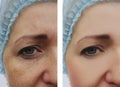 Woman face wrinkles pigmentation removal treatment health before and after procedures Royalty Free Stock Photo