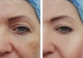 Woman face wrinkles pigmentation before and after procedures Royalty Free Stock Photo