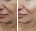 Woman face wrinkles pigmentation removal correction treatment health before and after procedures