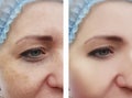 Woman face wrinkles pigmentation removal health before and after procedures Royalty Free Stock Photo