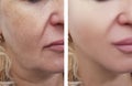 Woman face wrinkles pigmentation removal before and after procedures Royalty Free Stock Photo