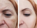 Woman face wrinkles pigmentation therapy aging removal before and after procedures Royalty Free Stock Photo