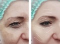 Woman face wrinkles before and after patient rejuvenation therapy difference procedures, arrow Royalty Free Stock Photo