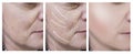 Woman face wrinkles before and after procedures, arrow skin tightening Royalty Free Stock Photo
