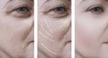 woman face wrinkles before and after therapy, collagen procedures, arrow Royalty Free Stock Photo