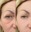 Woman face wrinkles puffiness correction effect before and after lifting treatment collage Royalty Free Stock Photo