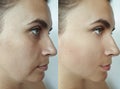 Woman face wrinkles regeneration filler cosmetology procedure tightening removal treatment collage