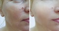 Woman face wrinkles regeneration lifting mature differencecosmetology before and after treatment