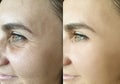 Woman face wrinkles regeneration procedure tightening removal treatment collage