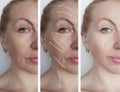 Woman face wrinkles before after regeneration  therapy hydrating treatment biorevitalization correction procedures, tension Royalty Free Stock Photo