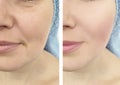 Woman face wrinkles before and after rejuvenation beautician therapy results collage effect Royalty Free Stock Photo