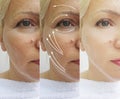 Woman face wrinkles before and after rejuvenation therapy results cosmetology treatment lifting Royalty Free Stock Photo