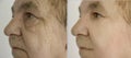 Woman face wrinkles removal lifting plastic correction filler collagen crease before and after treatment therapy