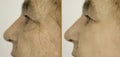 Woman face wrinkles removal plastic correction filler collagen crease before and after treatment therapy