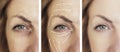 Woman face wrinkles removal results cosmetology patient medicine before and after difference treatment procedures, arrow Royalty Free Stock Photo