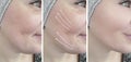Woman face wrinkles cosmetology arrow difference effect eye removal before and after treatment Royalty Free Stock Photo