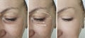 Woman face wrinkles before and after result procedure lifting regeneration orrection treatment Royalty Free Stock Photo