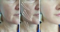 Woman face wrinkles before after thread procedure lifting treatment collage arrow Royalty Free Stock Photo