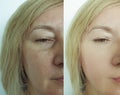 Woman face wrinkles before after thread rejuvenation plastic difference effect procedure lifting treatment collage Royalty Free Stock Photo