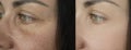 Woman face wrinkles beautician saggy crease blepharoplasty before and after treatment pigmentation