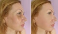 Woman face wrinkles before cosmetology saggy difference after treatment correction