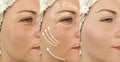 Woman face wrinkles before after saggy difference correction rejuvenation treatment, arrow