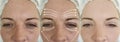 Woman face wrinkles after effect saggy tension plastic difference correction rejuvenation treatment, arrow