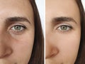 Woman face removal correction wrinkles before and after treatment collage