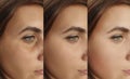 Woman face wrinkles before, contrast after treatment collage