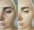 Woman wrinkles regeneration filler cosmetology procedure tightening removal treatment collage