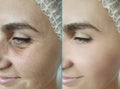 Woman face wrinkles sagging beautician removal before after treatment collage