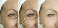 Woman face wrinkles before and after procedure lifting regeneration orrection treatment Royalty Free Stock Photo