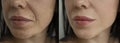 Woman face wrinkles problem plastic correction filler collagen crease before and after treatment therapy