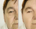 Woman face wrinkles results removal lifting plastic correction filler collagen crease before and after treatment therapy