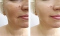 Woman face wrinkles before and after   lifting results  therapy  rejuvenationtreatment difference Royalty Free Stock Photo